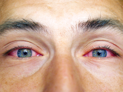 Weed eyes, or "stoned eyes," refer to dilated or pinpoint pupils, bloodshot or water eyes, and rapid or controllable eye movement after smoking weed, eating an edible, or ingesting cannabis in any form.